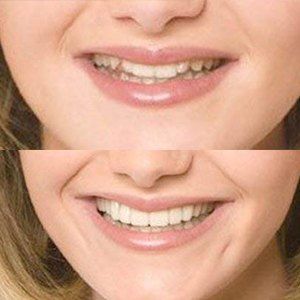 before and after snap on smile