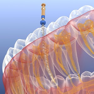Illustration of tool being used to perform root canal therapy