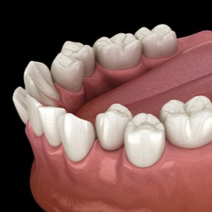Illustration of crowded teeth