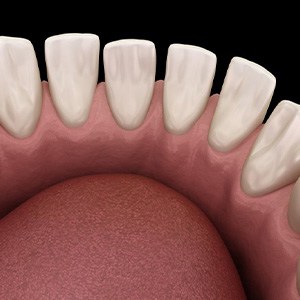 Illustration of teeth with gaps