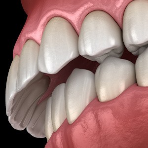 Illustration of overbite