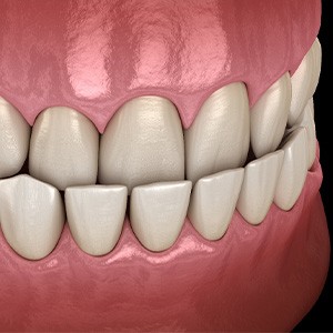 Illustration of underbite
