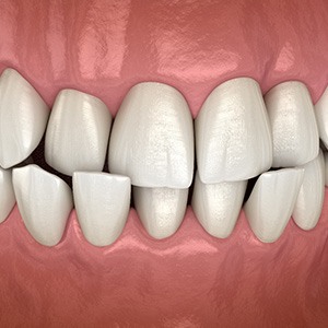 Illustration of crossbite