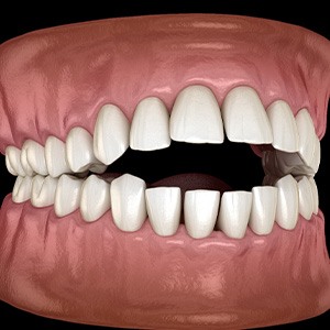 Illustration of open bite