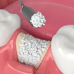 diagram of an advanced implant procedure in Costa Mesa