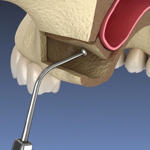 image of sinus lift