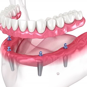 a 3 D illustration of All on 4 implants
