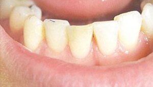 teeth bleaching after