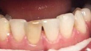 teeth bleaching before
