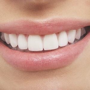 smile with cosmetic bonding