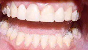 cosmetic dental bonding after