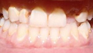 cosmetic dental bonding before