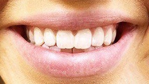 cosmetic dental bonding after