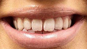 cosmetic dental bonding before