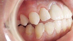 cosmetic dental bonding after