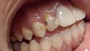 cosmetic dental bonding before