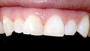 cosmetic dental bonding after