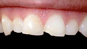 cosmetic dental bonding before