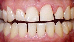 cosmetic dental bonding after