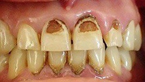 cosmetic dental bonding before