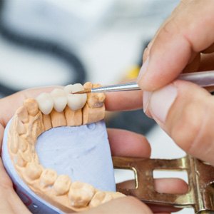 dentist creating dental bridge in Costa Mesa