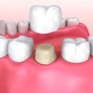 Digital model of dental crown procedure