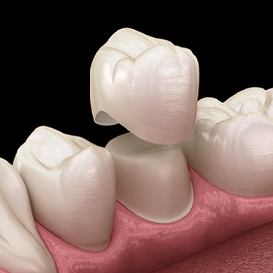 Model of crown being placed over a tooth