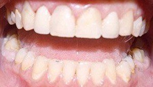 dental crowns after