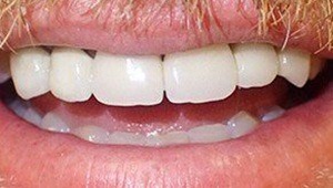 dental crowns after