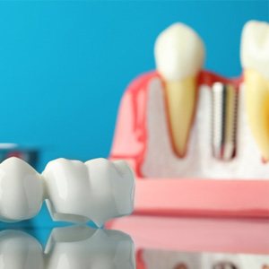 A dental bridge near an implant model against a blue background
