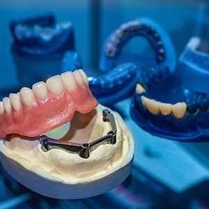 Implant dentures in Costa Mesa