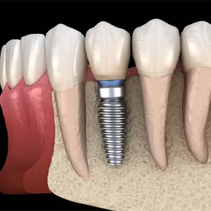 dental implant integrating with the jawbone
