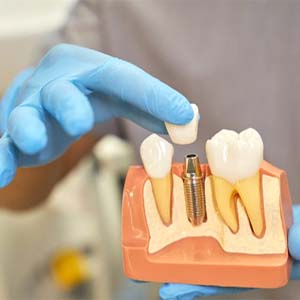 dentist placing a crown on a dental implant model