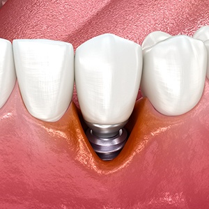 Illustration of receding gums around a dental implant