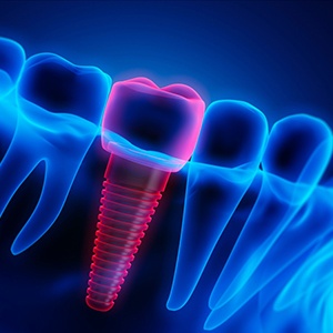 Illustration with dental implant highlighted in red