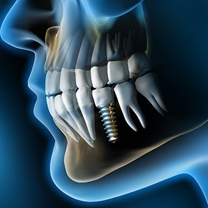 X-ray of a patient with a dental implant in Costa Mesa