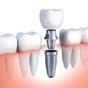 dental implant post, abutment, and crown