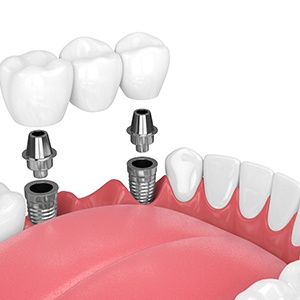 dental bridge with two implants