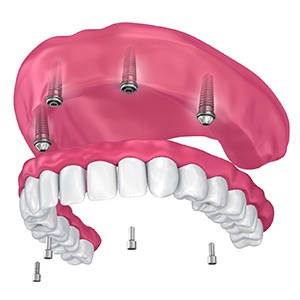 implant denture on the upper arch