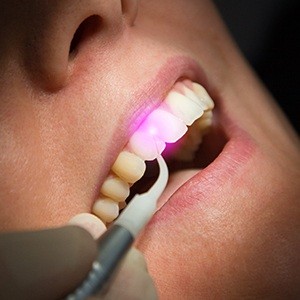laser on teeth