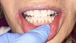 lower porcelain veneers after