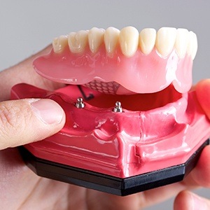 oral denture procedure