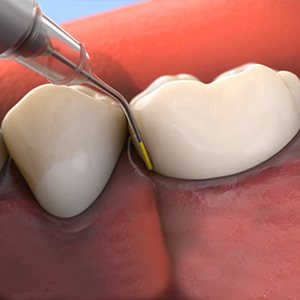 illustration of antibotic therapy