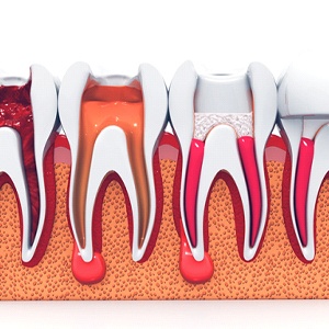 model showing each step of root canal