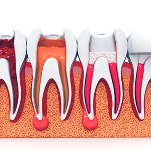 model showing each step of root canal