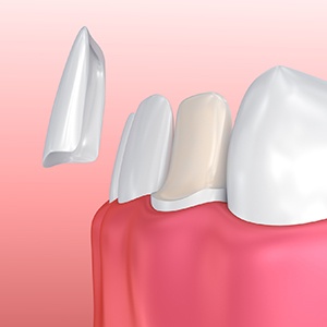 illustration of porcelain veneer