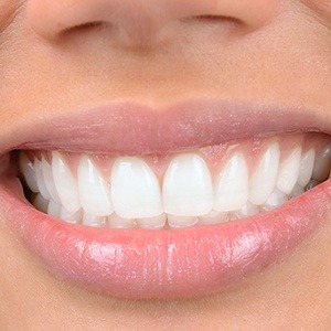 smile with cosmetic bonding