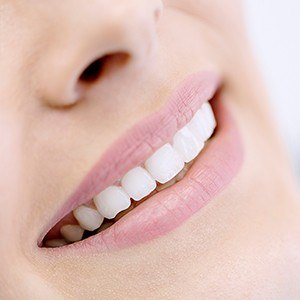 smile with veneer