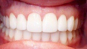 porcelain veneers after