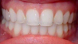 porcelain veneers before